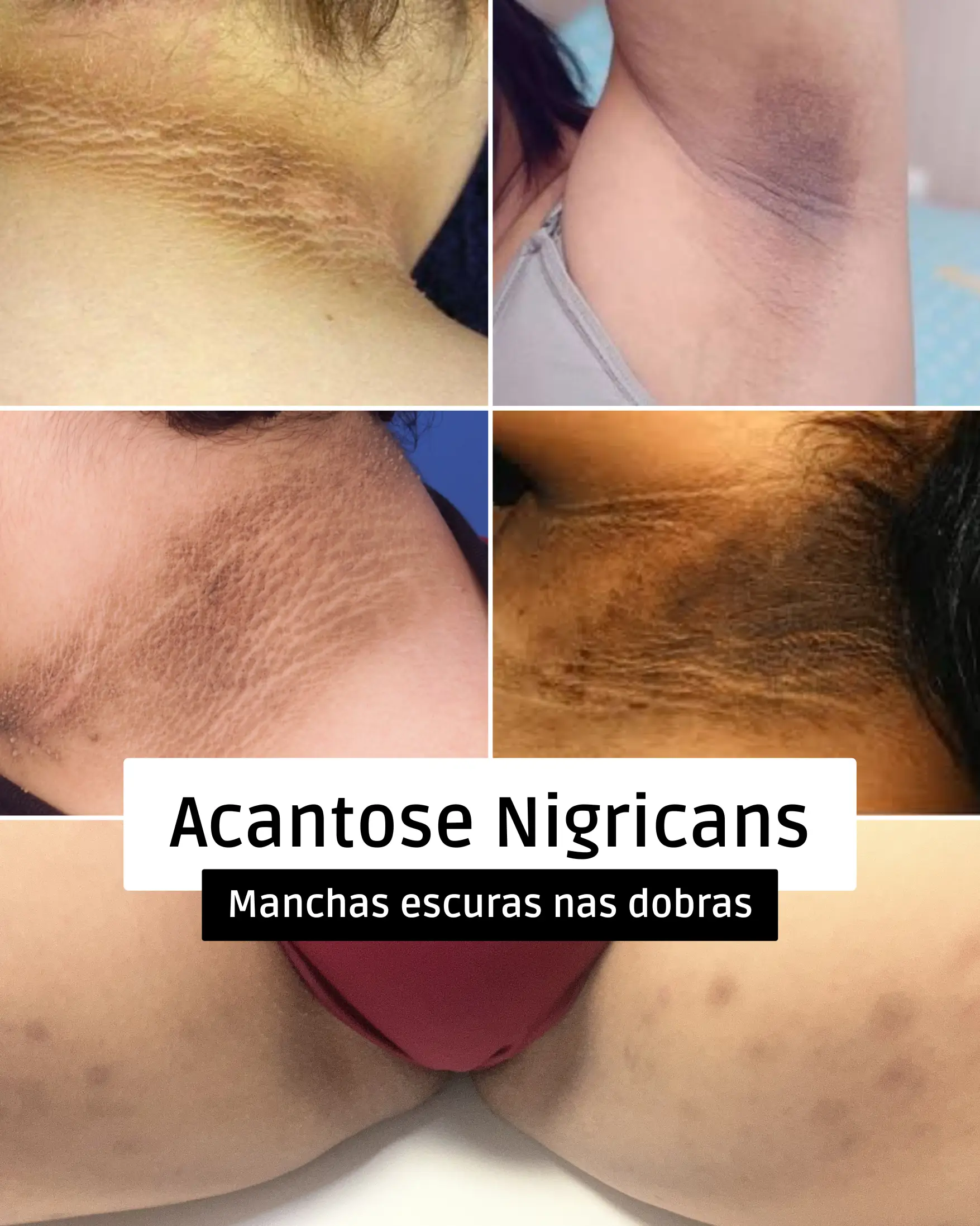 Acantose Nigricans: manchas escuras nas dobras da pele, pescoço, axilas e virilha