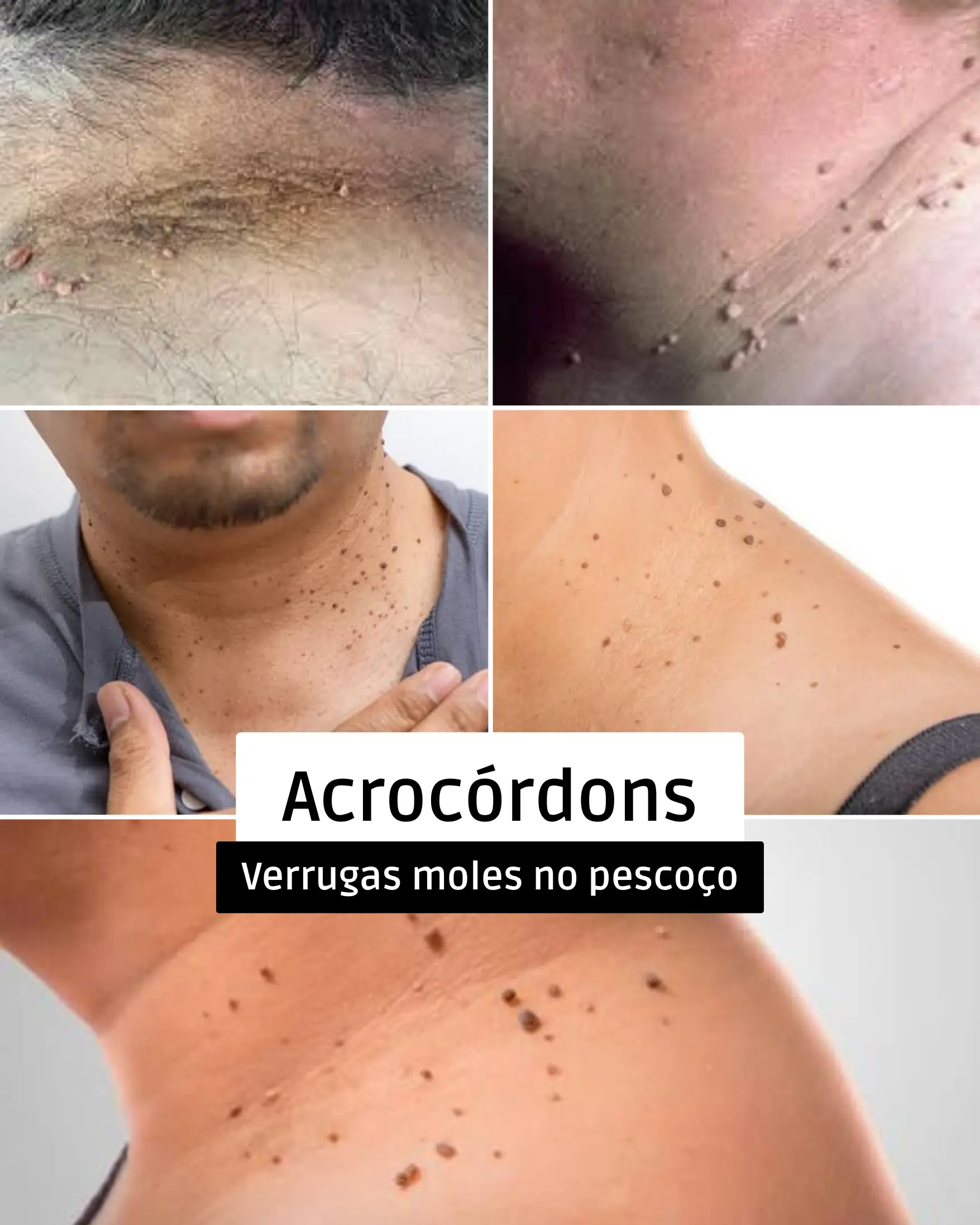 Acrocórdons: verrugas moles no pescoço e nas axilas