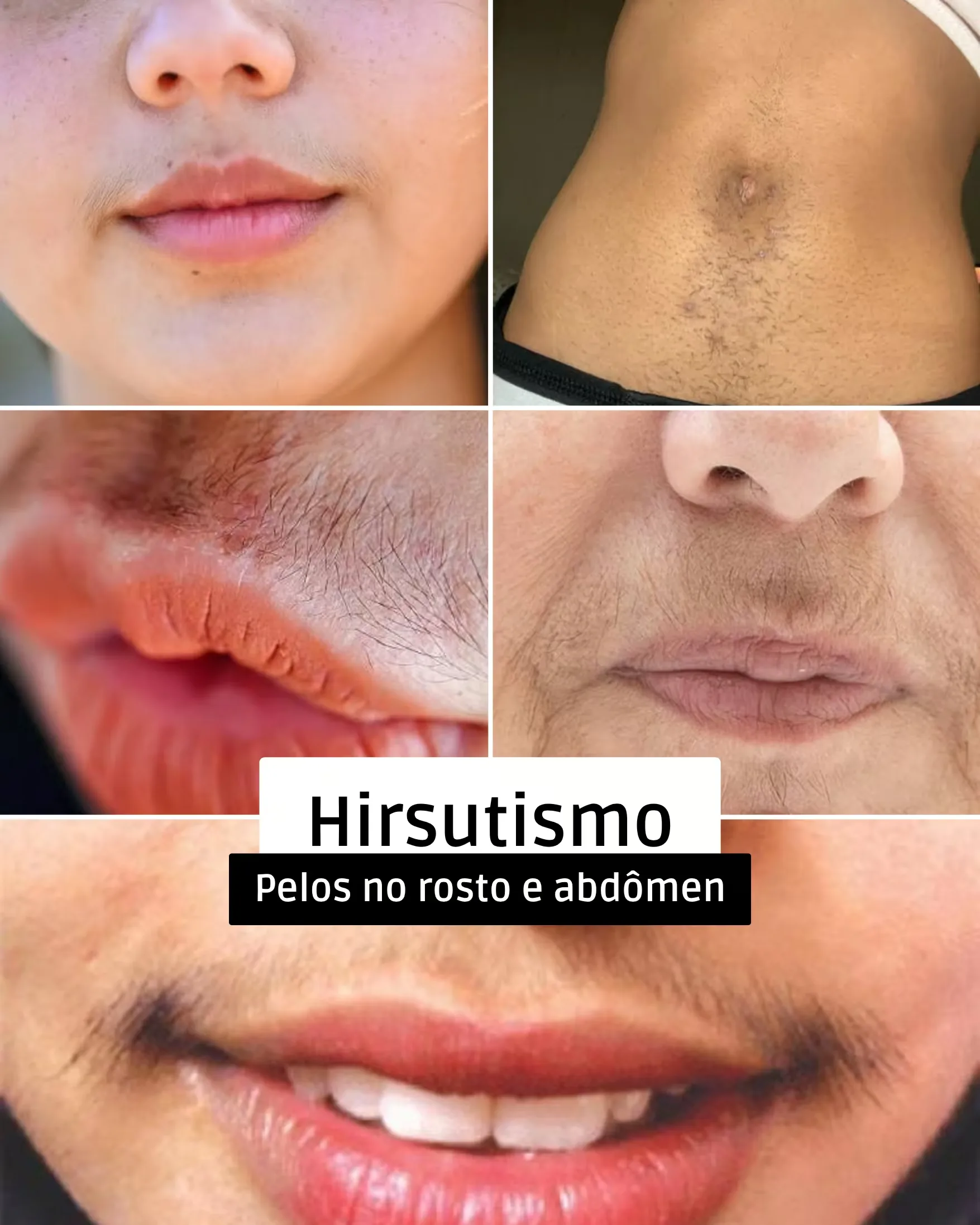 Hirsutismo: pelos no rosto e no abdômen