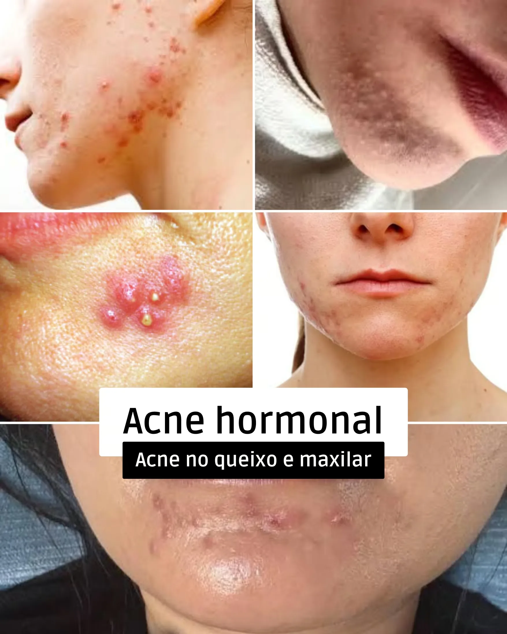 Acne hormonal: acne no queixo e no maxilar